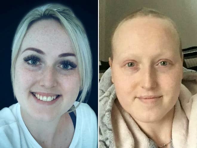 Sarah Boyle before she was wrongly diagnosed with breast cancer and after treatment (Sarah Boyle/SWNS)
